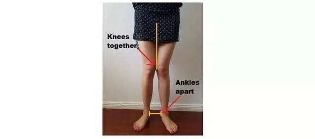 如何改善膝盖内旋腿型,膝盖老是向前弯曲