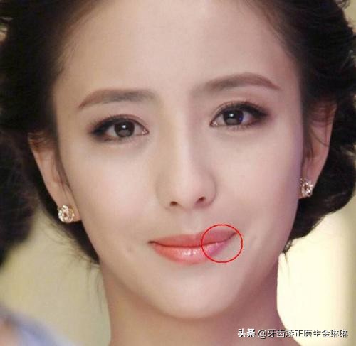 老虎牙隐形矫正的全过程,虎牙齿缝隙大如何矫正