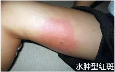 娃身上出了荨麻疹怎么办,娃儿有皮疹怎么止痒