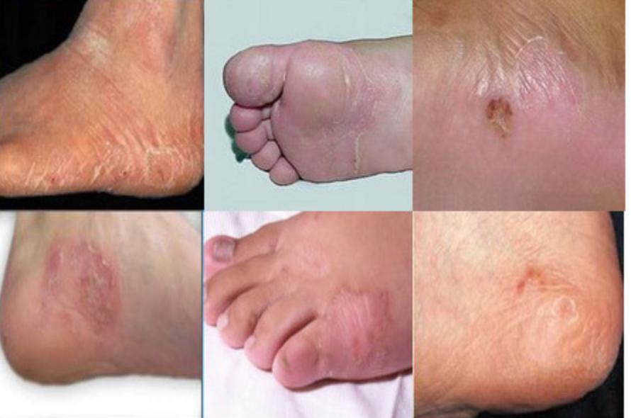 脚臭袜子臭,脚臭穿什么材质袜子