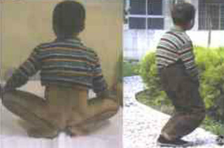 打臀部针后臀肌挛缩,小针刀治疗臀肌挛缩症安全吗