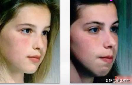 怎么防止宝宝的牙齿长成地包天,宝宝牙齿不齐导致地包天