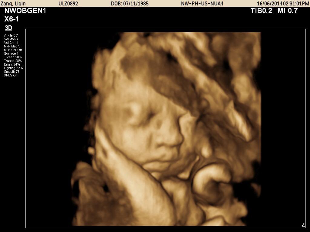 四维图片看着胎儿鼻子大怎么回事,胎儿四维彩超显示脑门大