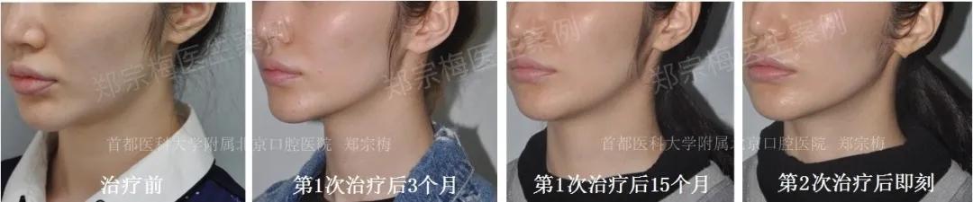 fotona4d有效果吗,fotona4d做完前后对比