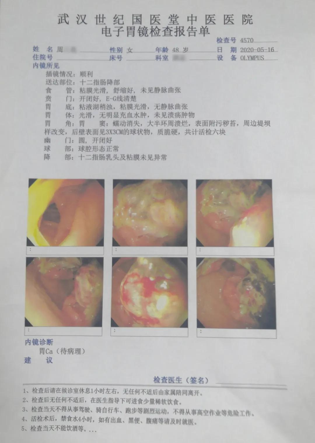 年轻男子吃三餐却查出胃癌晚期,一日三餐规律为什么还会得胃癌