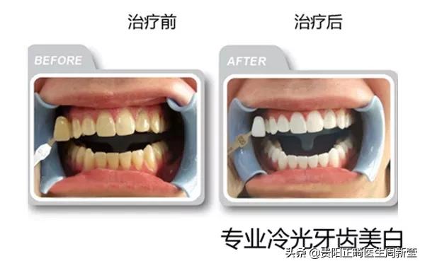 市面上冷光美牙仪真的有用吗,蓝光美白牙仪真的管用吗