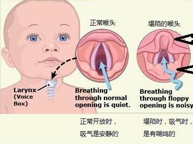 新生儿喉咙有痰呼吸有声音,新生儿嗓子里有痰的声音