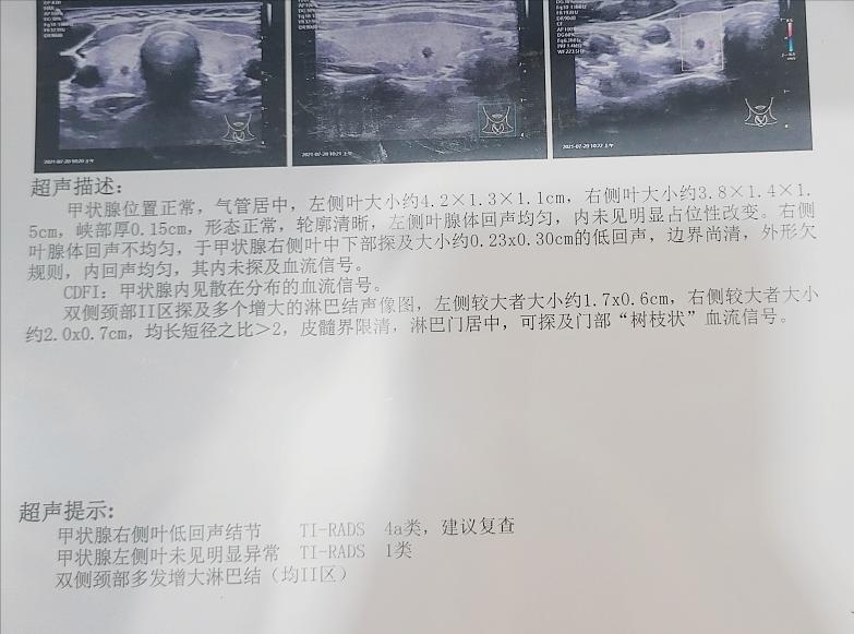 甲状腺有淋巴结怎么能消除,甲状腺淋巴结节有什么办法消除