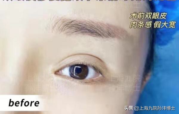 19岁全切双眼皮恢复图真实,眼修复手术