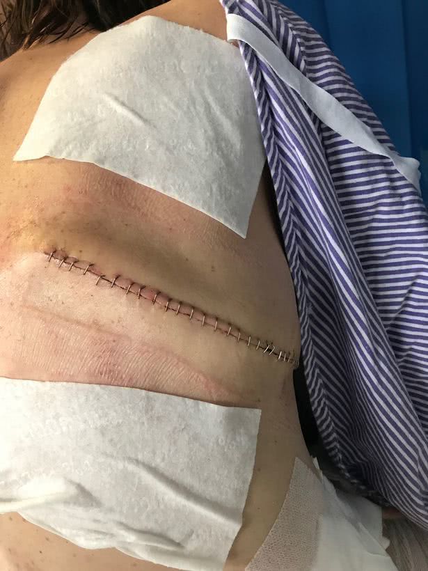 食道癌转移到结肠,食道癌加结肠癌手术