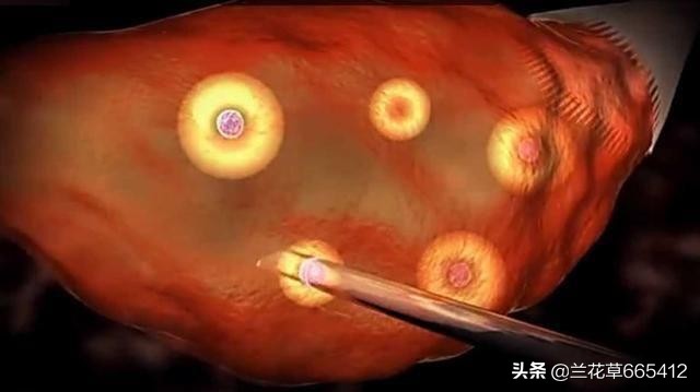 试管婴儿到底有多痛？7张图为你“*放播**”整个过程。