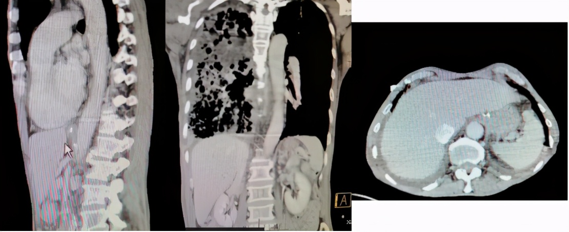 慢阻肺伴有急性加重能活几年,慢阻肺为什么会流鼻水