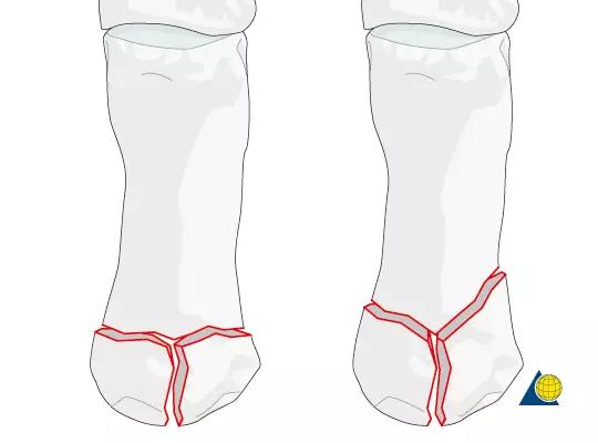 所有骨折都叫什么名字,骨折的名称有哪些