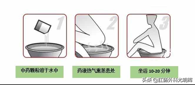 痔疮手术后水肿厉害怎么办,痔疮术后水肿不修剪行吗