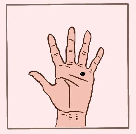 祛了黑痣几年后还有痣怎么办,从小就有黑痣要不要祛除