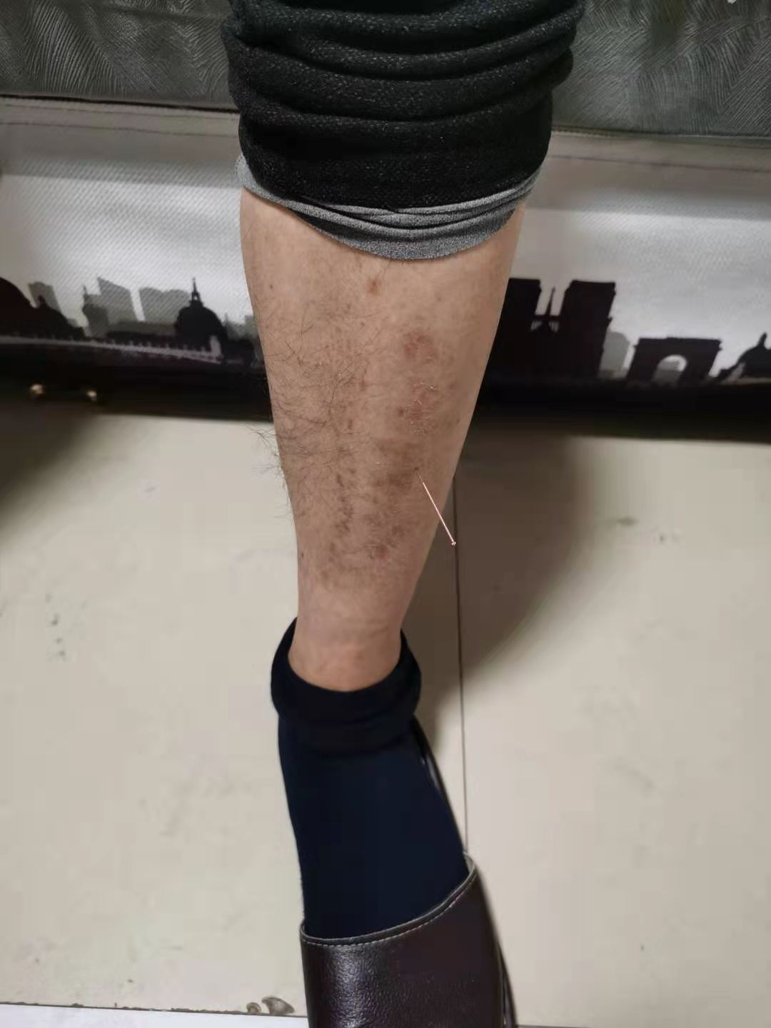 针灸治疗颈肩腰腿痛,针灸治疗颈肩腰腿痛的可行性分析