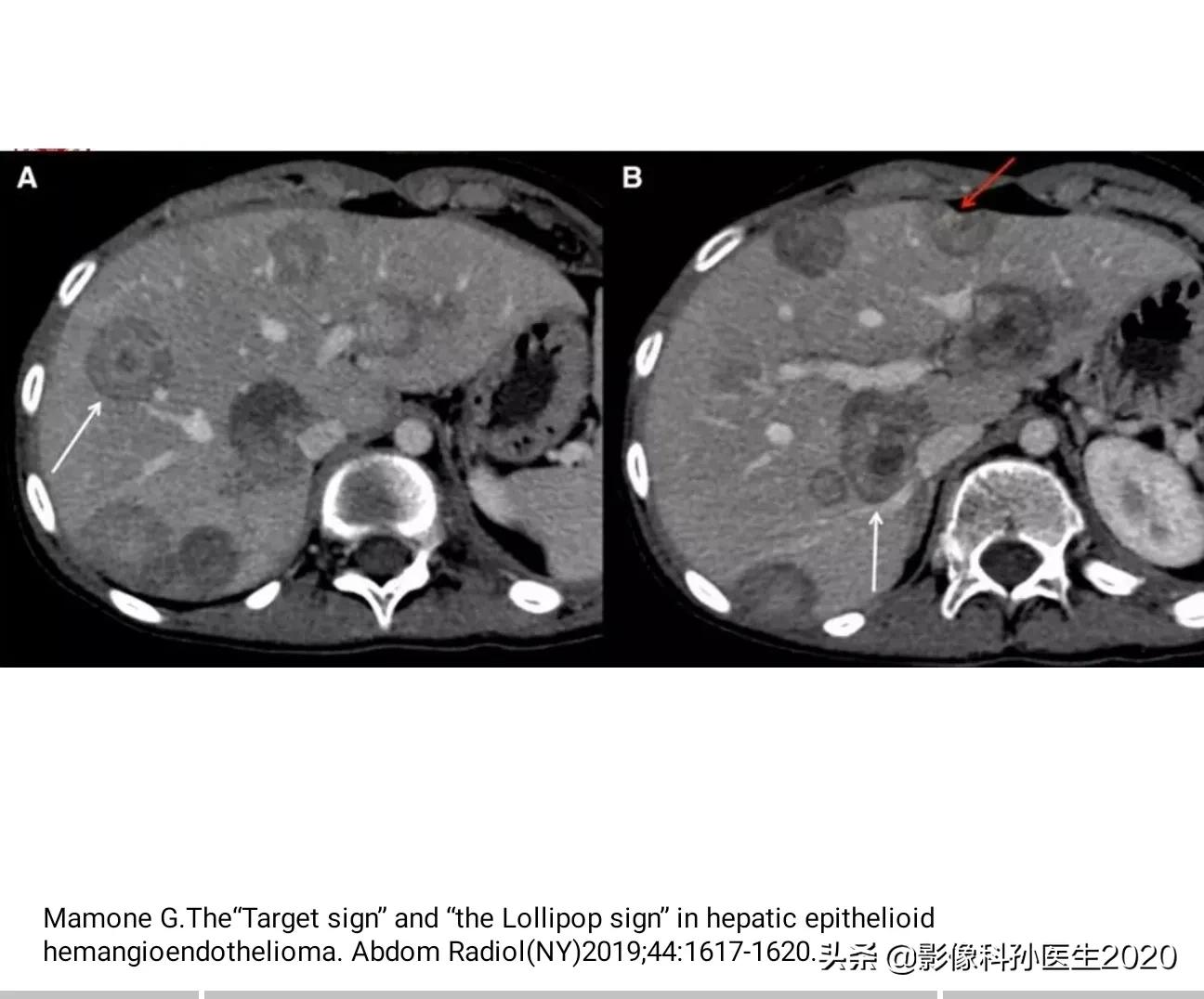 肝上皮样血管内皮瘤全国多少例,肝上皮样血管内皮瘤超声表现