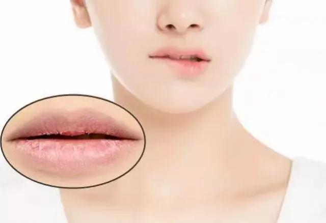 鼻孔干燥结痂嘴唇干燥起皮怎么办,嘴唇干燥开裂无法愈合