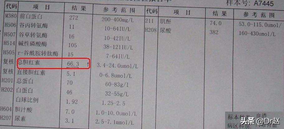 黄疸原因及诊疗,黄疸是什么原因引起的怎样治疗