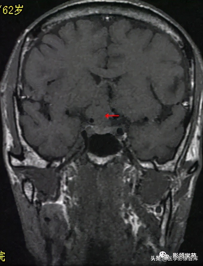 鞍区肿瘤做什么检查得出来,鞍区肿瘤的影像学鉴别