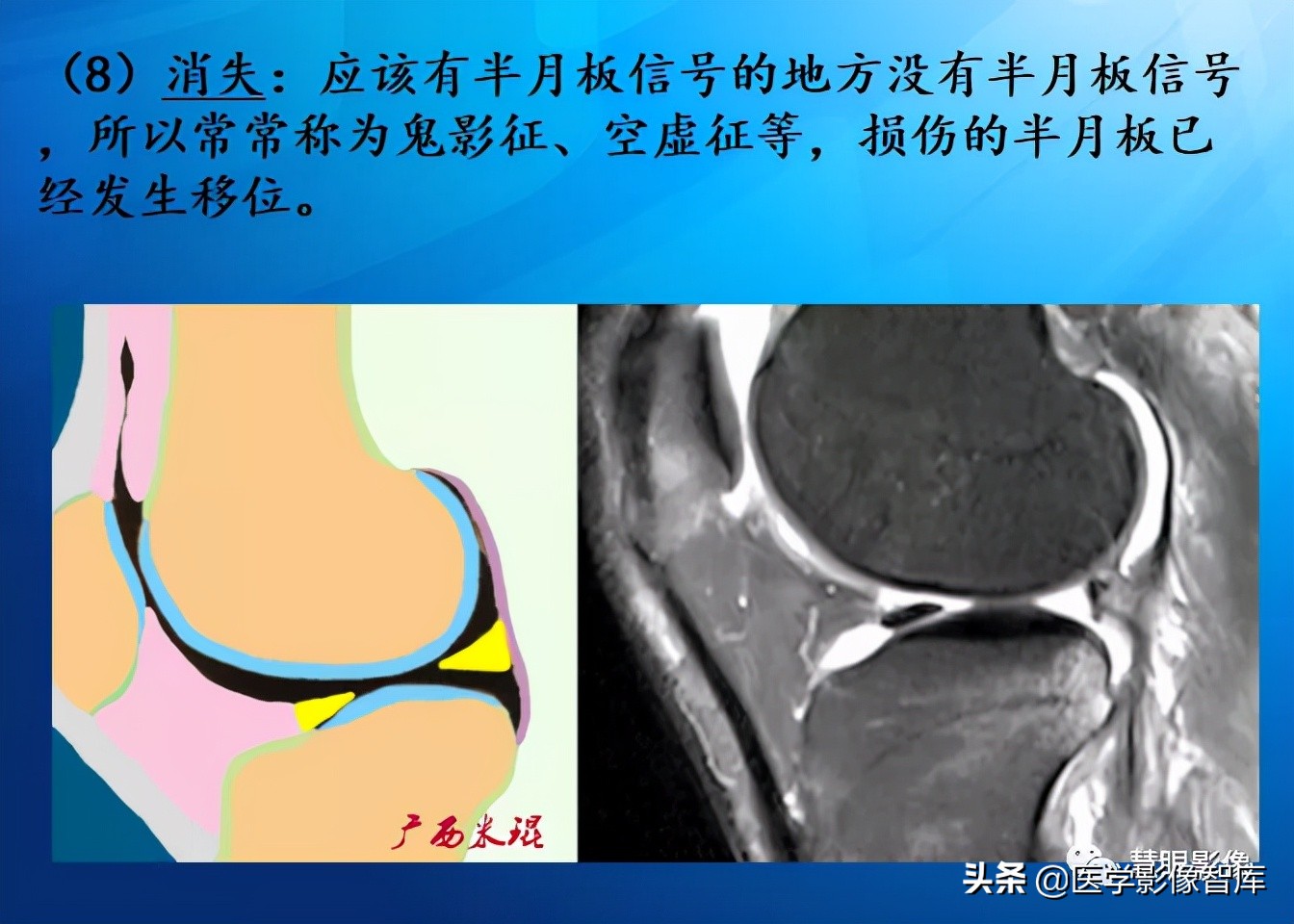 膝关节半月板损伤的解剖结构图,半月板mri解剖图解