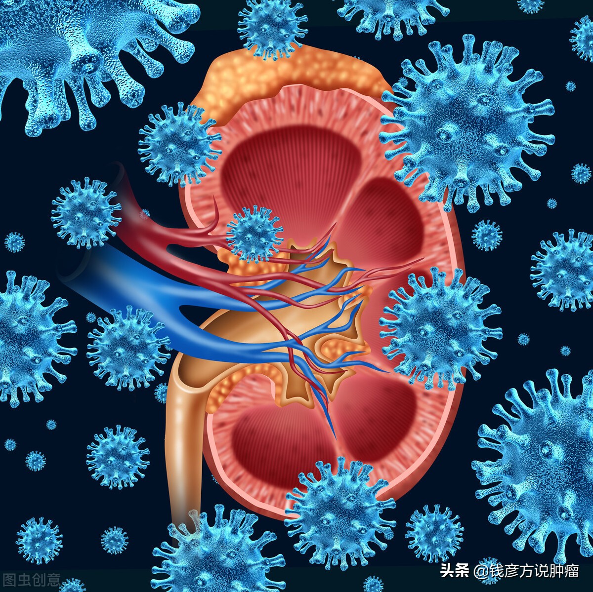 肾癌早期的6个防癌方法,肾癌中度