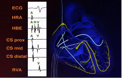 室早患者关注事项,室早严重会对身体有多大影响