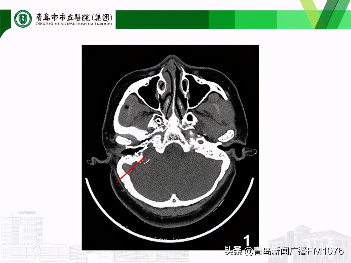 大妈脸不停抽搐，原是耳朵里藏了个大肿瘤，市立专家挑战高难度走位巧摘瘤