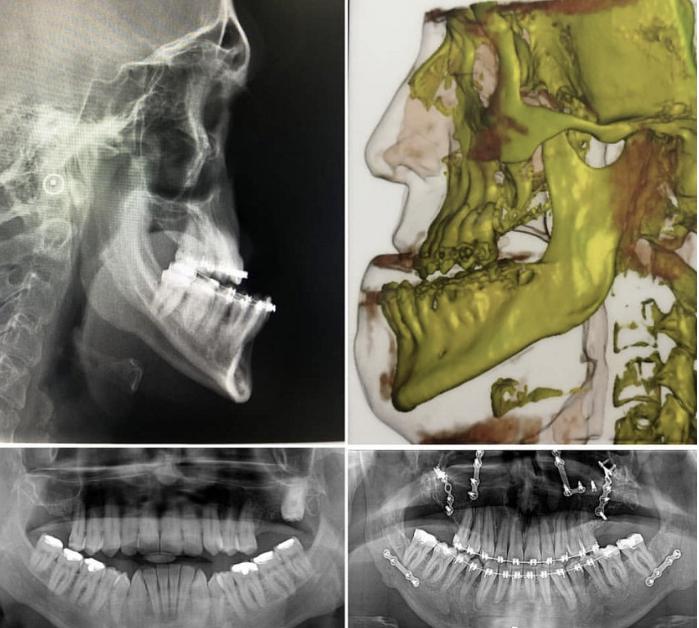 骨性龅牙怎么弄,如何判断骨性龅牙的轻重程度