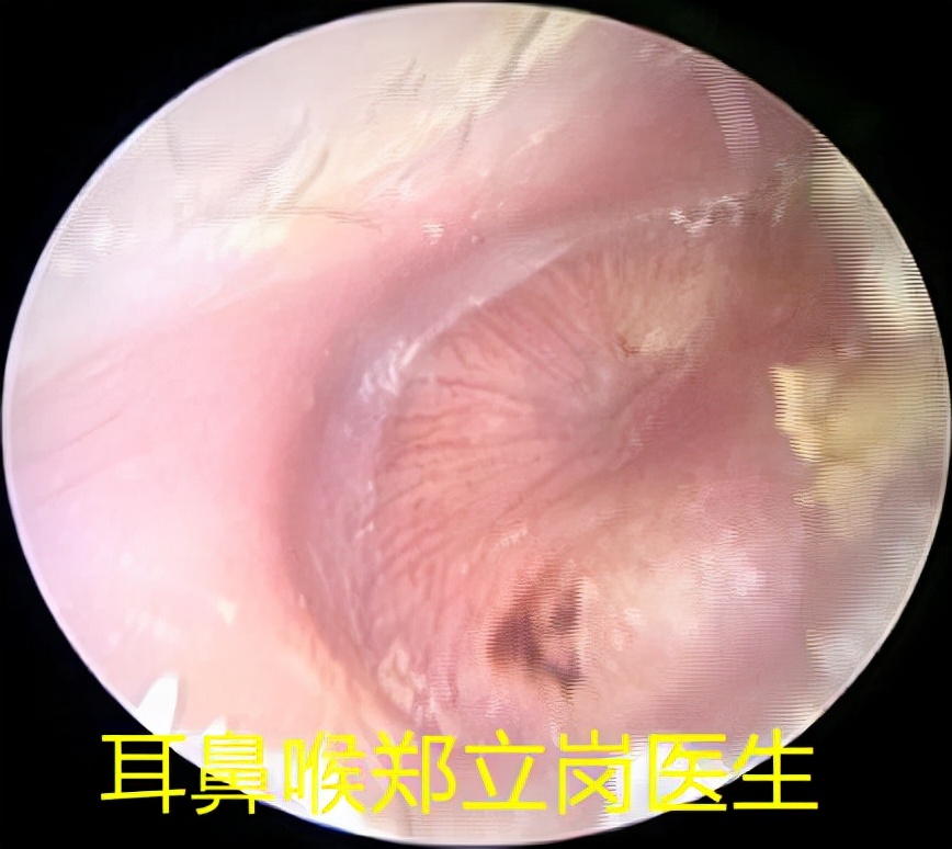 儿童中耳炎乳突炎怎么治疗,孩子7岁得了中耳乳突炎