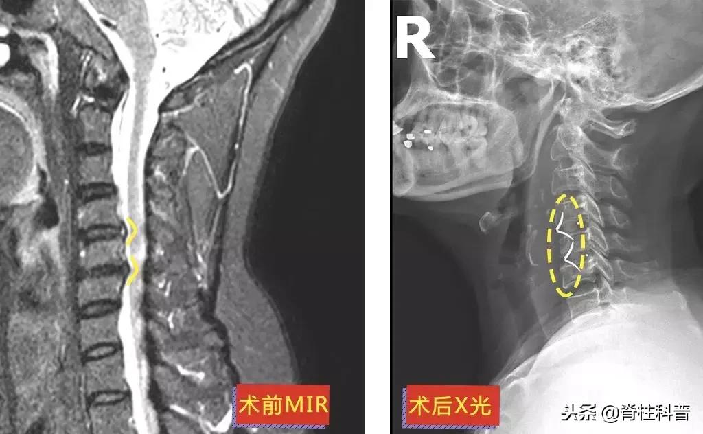 颈椎病治疗的分享,关于颈椎病通俗易懂的科普