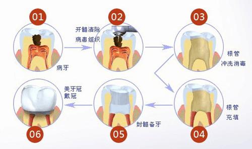 镶牙之前必须要拔掉残根吗？残根该怎么处理？牙科专家来解疑