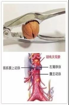 出现血尿就真的患了肾脏疾病吗？