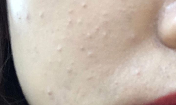 闭口粉刺去美容院清闭口好吗,如何正确去除粉刺闭口