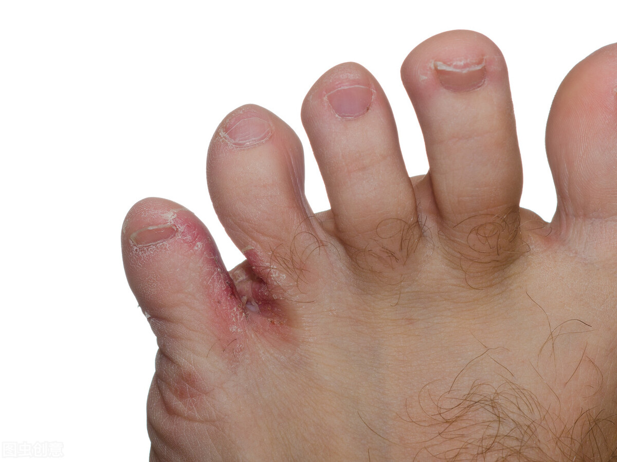 脚气怎么治专家现场演示,如何治脚气和脚汗