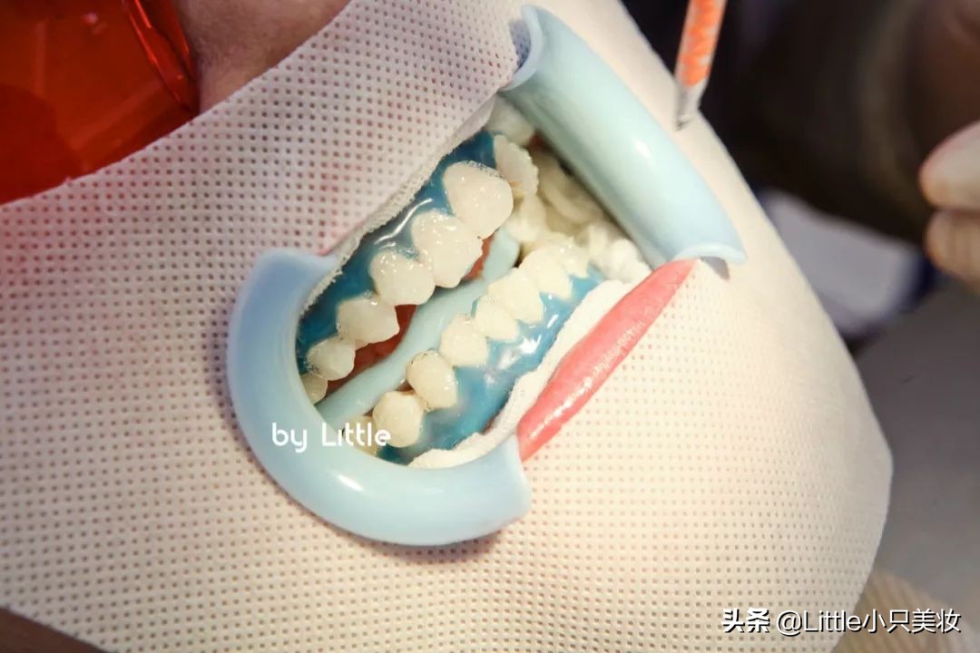 黄牙妹用什么美白,最全牙齿美白攻略