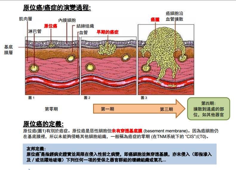什么是乳腺浸润性癌二级,乳腺浸润癌与原位癌的区别