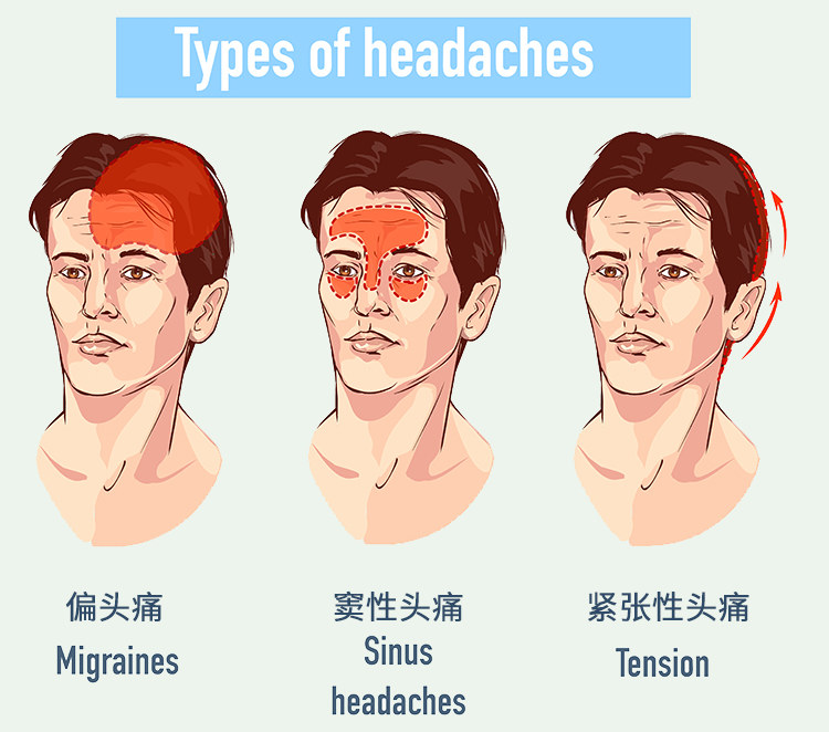 头痛不是简单的问题,头痛不是病痛起来真要命