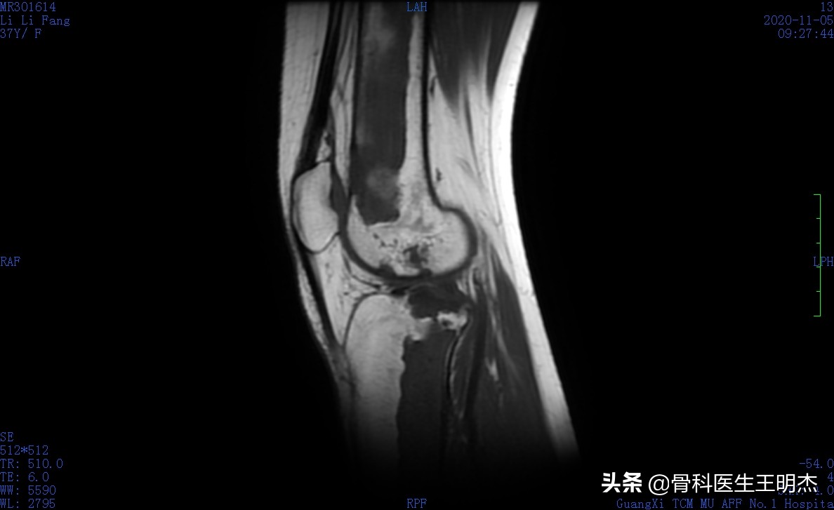 骨梗死是骨癌吗,骨梗死的治疗