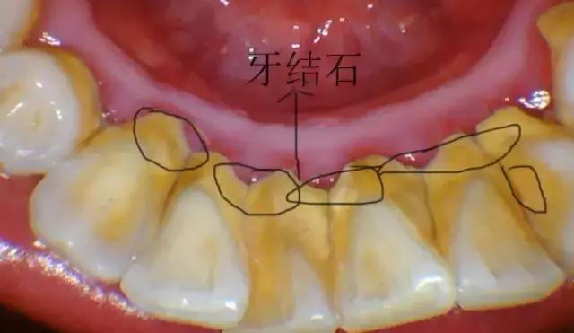 洗牙时医生说我牙龈萎缩严重,洗牙后牙齿酸软怎么办