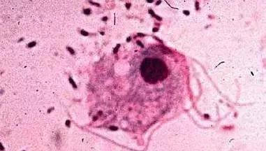 尴尬！用避孕套竟患霉菌性阴道炎