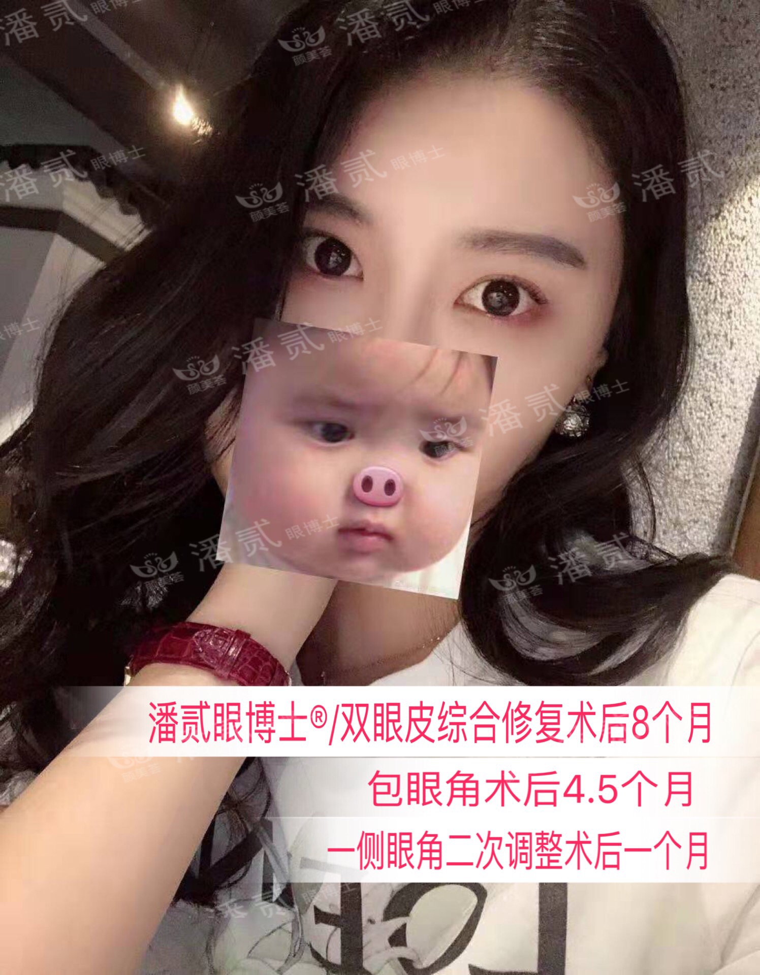 开内眼角会留疤的照片,开内眼角的疤痕变白色了怎么办