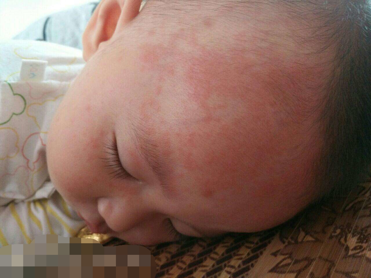 过敏宝宝为什么这么多,过敏体质的宝宝越来越多