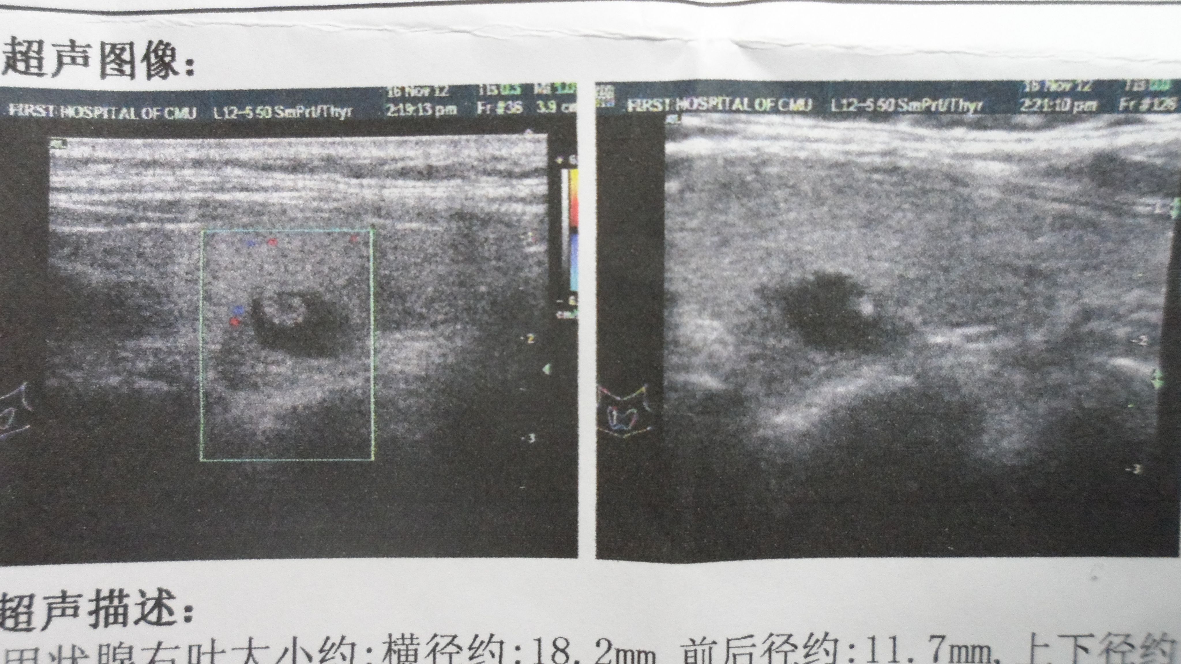 王玉芬教授：彩超报告，无回声、低回声、强回声是什么意思？
