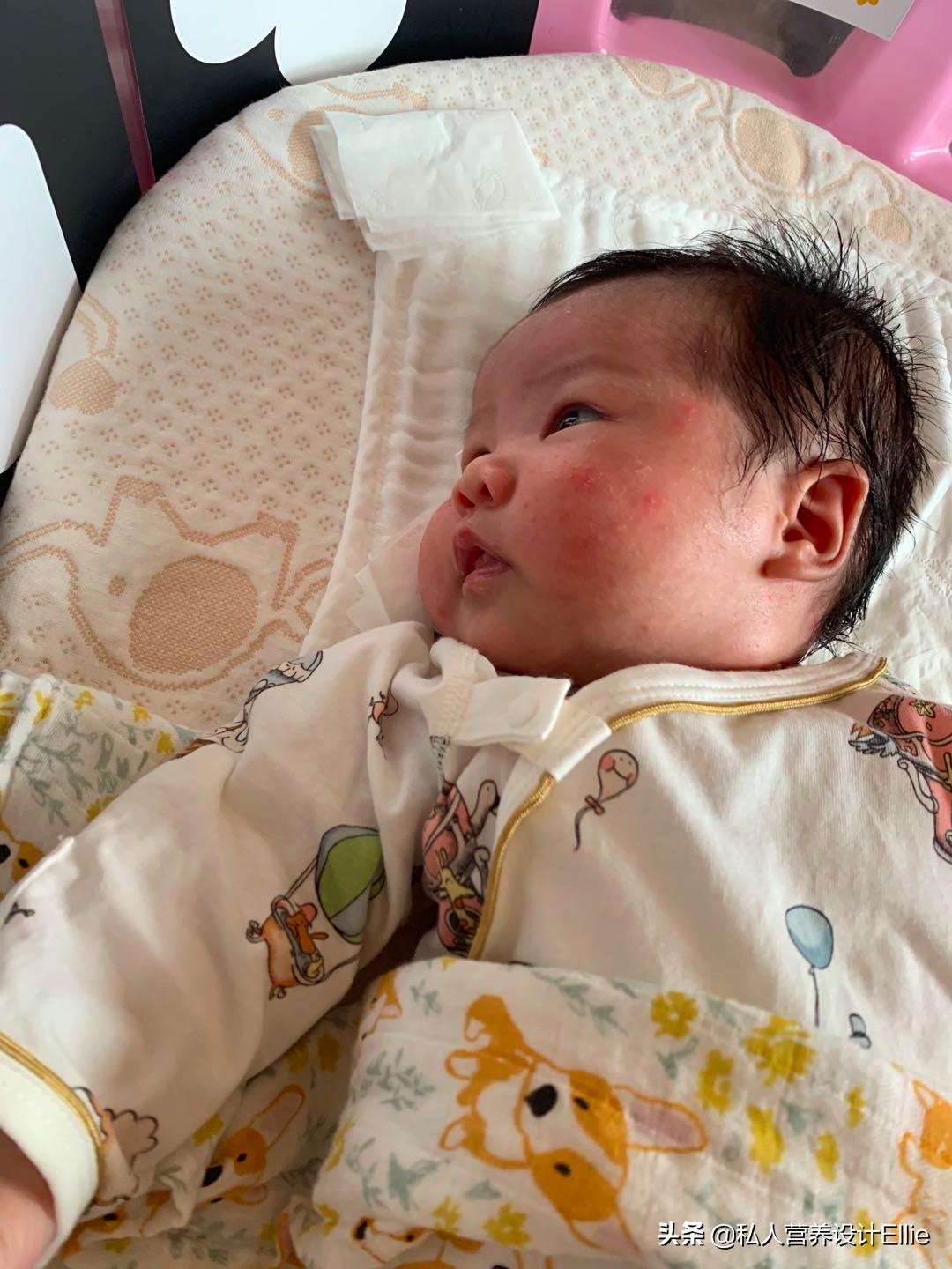 月子里宝妈出现湿疹忌口,月子宝宝湿疹是怎么引起的