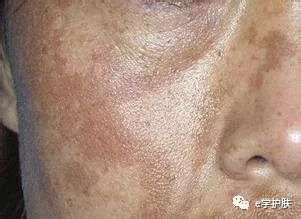 痘印和色斑怎么区别,痘印和斑点肌肤怎么护理