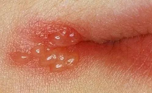 嘴唇长泡引起溃烂,嘴唇上火起水泡和疱疹区别