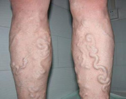 总是感觉小腿肚酸疼是什么原因,经常感觉小腿肚子酸胀中医怎么说