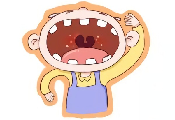 疱疹性咽峡炎有办法预防吗,疱疹性咽峡炎痊愈后要关注什么