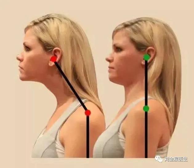 四个动作教你自测颈椎,探颈体态纠正